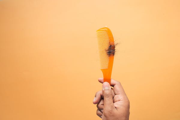 Mengenal Penyakit Alopecia, Penyebab Rambut Rontok hingga Botak 6 Diagnosis Alopecia - Womanindonesia.co.id