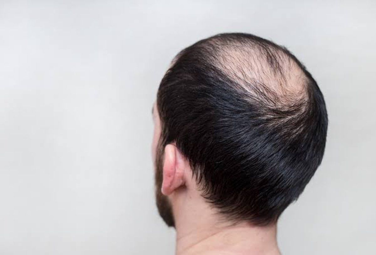 Istilah dan penyebab Alopecia - Womanindonesia.co.id