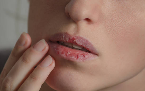 Tips Bibir kering agar sehat alami - Womanindonesia.co.id